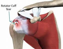 rotator cuff tear