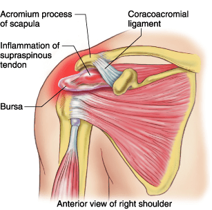 supraspinatus impingement