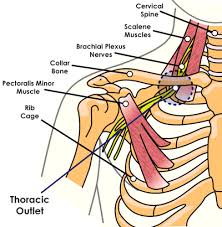 Thoracic Outlet Syndrome | castlebodywork
