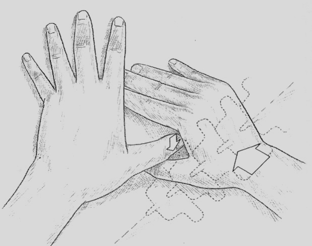 Induration Technique